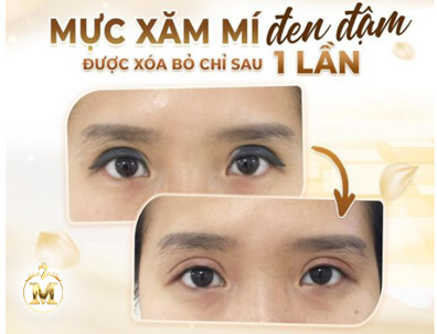 HÚT MỰC XĂM MÍ MẮT